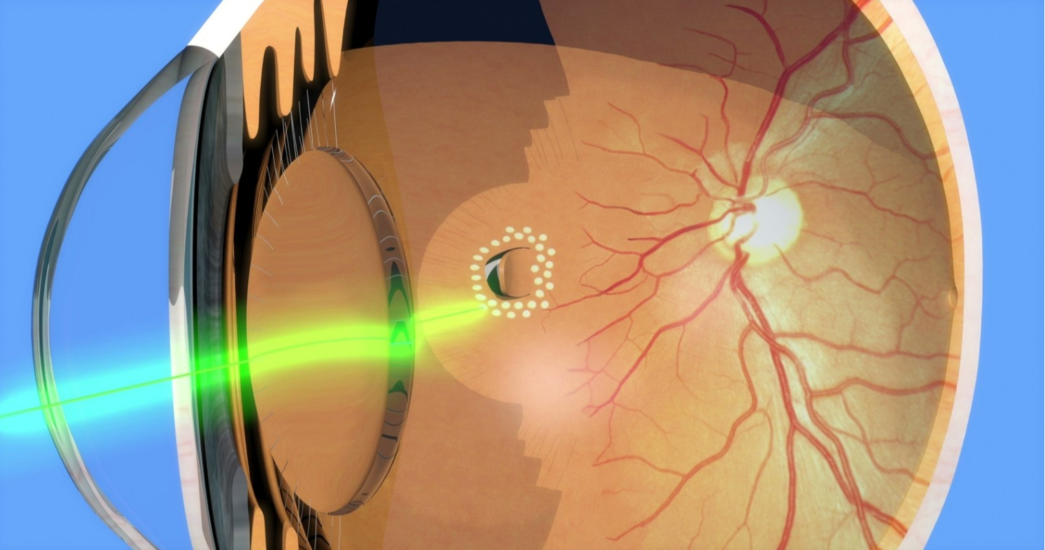 视网膜裂孔的图片.png